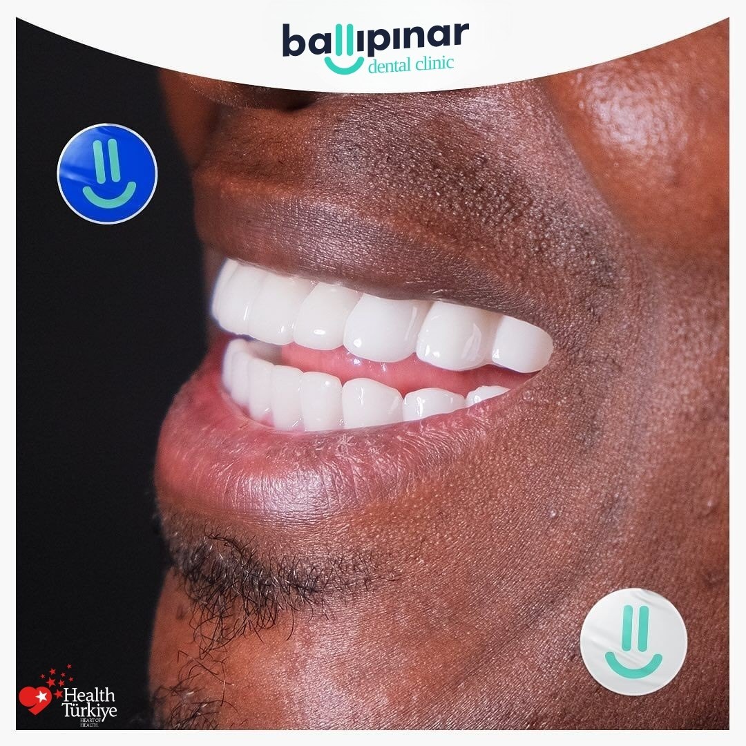 Revolutionize Your Smile with All on 4 Dental Implants