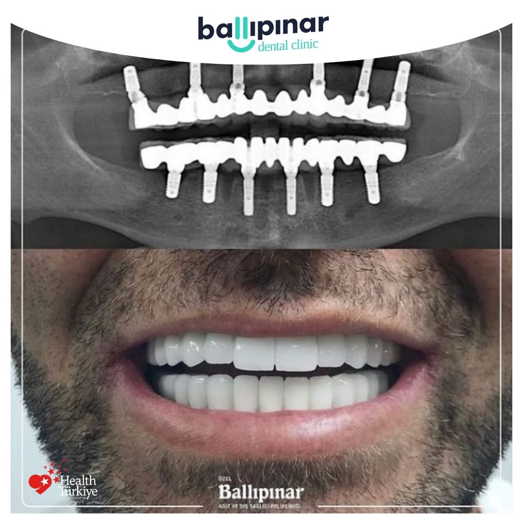 Transformative Dental Implants Services